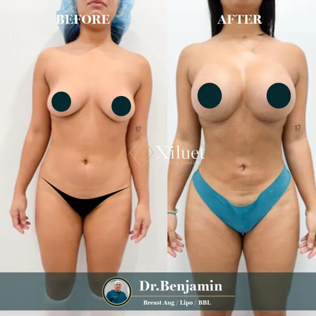 Breast augmentation + lipo + BBL · Dr. Benjamin Liliav