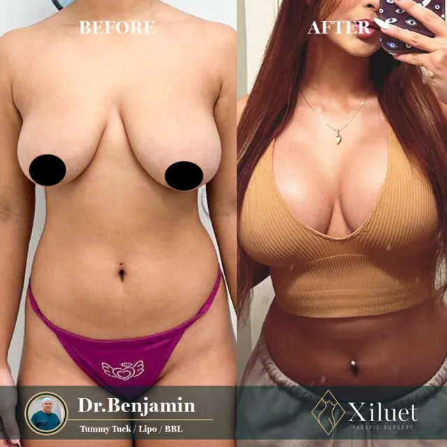 Tummy tuck + lipo + BBL · Dr. Benjamin Liliav