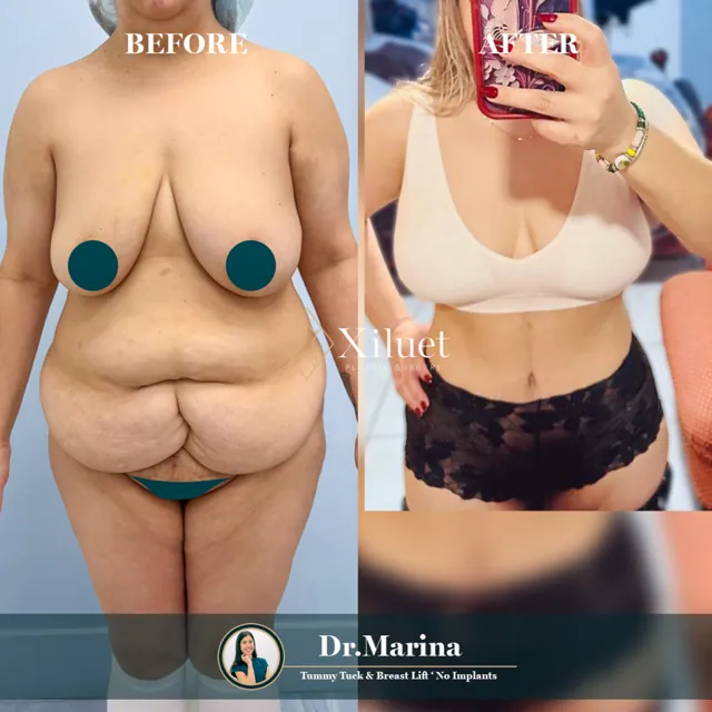 Breast lift, no implants · Dr. Marina Zorrilla