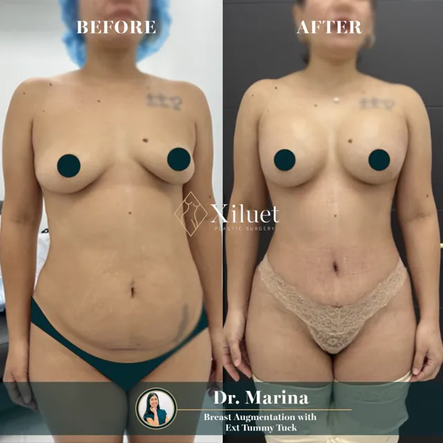 Breast augmentation + extended tummy tuck · Dr. Marina Zorrilla