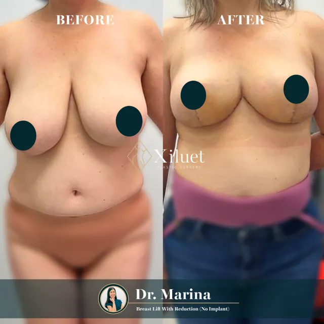 Breast lift with reduction, no implant · Dr. Marina Zorrilla
