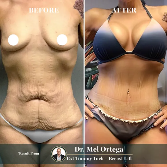 Extended tummy tuck + breast augmentation · Dr. Mel Ortega