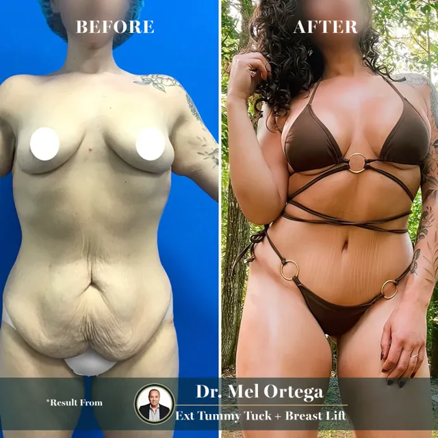 Extended tummy tuck + breast lift · Dr. Mel Ortega