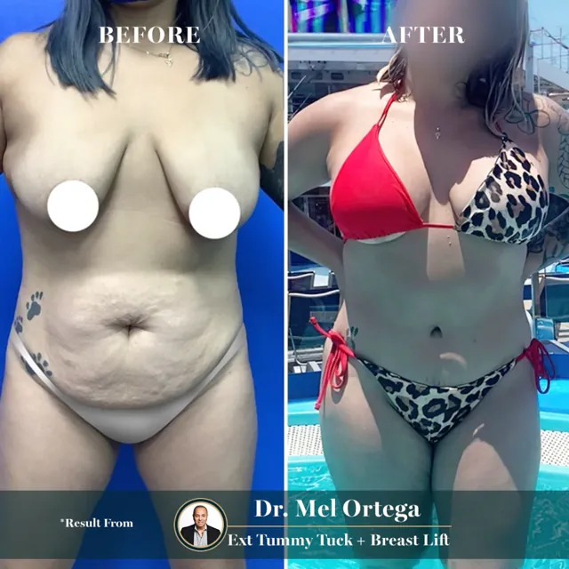 Extended tummy tuck + breast lift · Dr. Mel Ortega